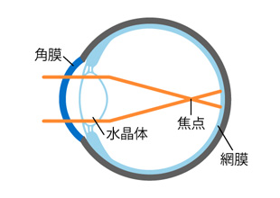 A)装用前(近視の状態)