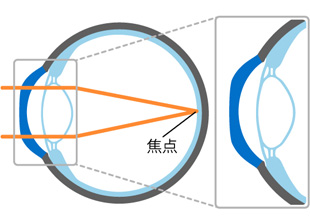 C) 装用後(裸眼時)